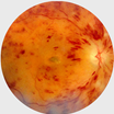 An image of an eye with non-diabetes-related issues. 