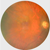 An image of an eye with unassessable results